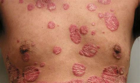 Psoriasis Severity Linked To Increased Risk Of Type 2 Diabetes