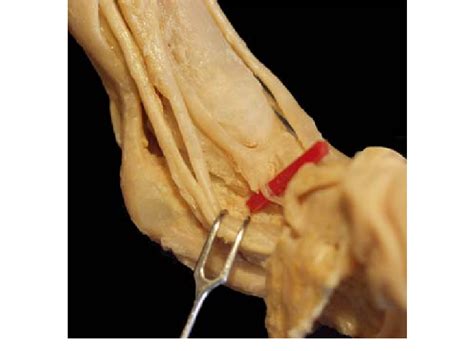 These components work in concert to produce smooth and efficient flexion of the individual digits of the hand. Medial view of a left clubfoot specimen (grade III). The tendon of the... | Download Scientific ...