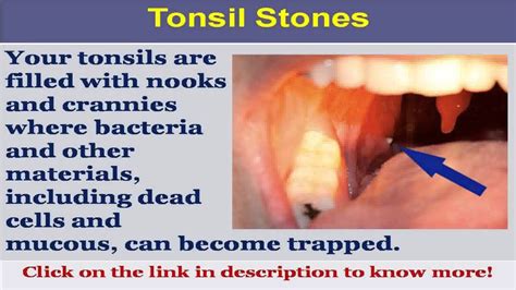 See Now Black Tonsil Stones Youtube
