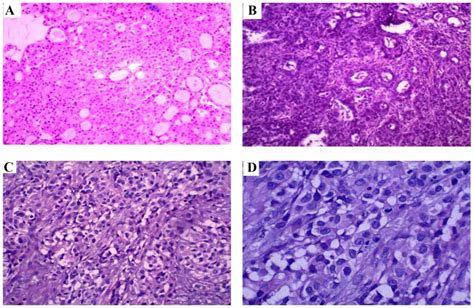 Mesothelioma markers were universally negative and cytokeratin was focally reactive only in some epithelioid cells. Malignant mesothelioma of the tunica vaginalis testis: A ...