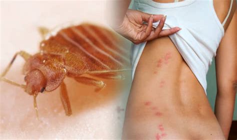 4 Signs Of Bed Bugs And A Remedy For Bug Bites Hopingfor Blog