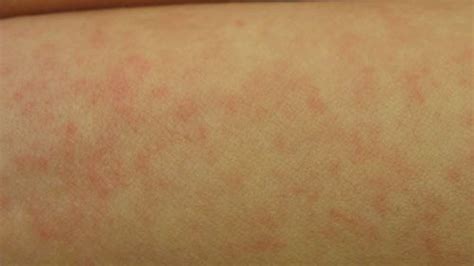 Anxiety Stress Hives Are Hives Dangerous And How To Treat Hives