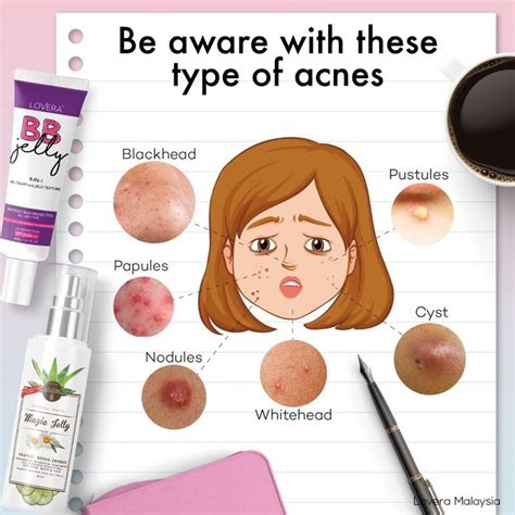 Acnes Haunt Your Life Don T Be Afraid I Have The Best Solution For Your Acnes Problem All
