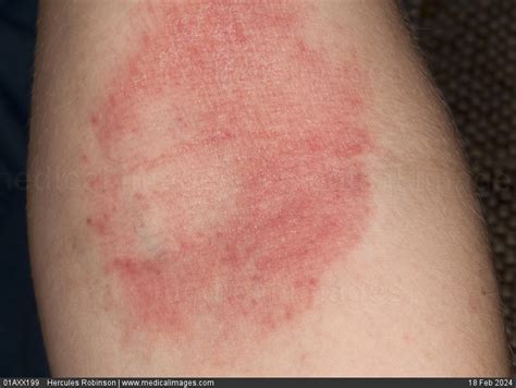 Stock Image Dermatology Atopic Eczema A Scaly Erythematous Patch In