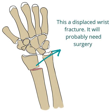 Types Of Distal Wrist Fractures