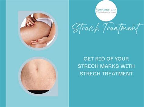 get rid of your stretch marks with striort stretch marks treatment estheticland
