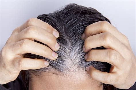 Most Common Types Of Hair Loss Know Them To Handle Them