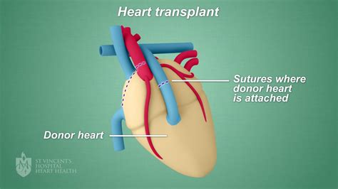 Heart Transplant St Vincents Heart Health