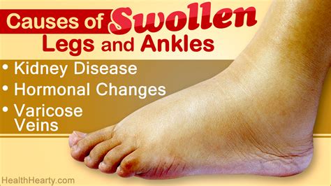 Causes Of Swollen Legs And Ankles Health Hearty