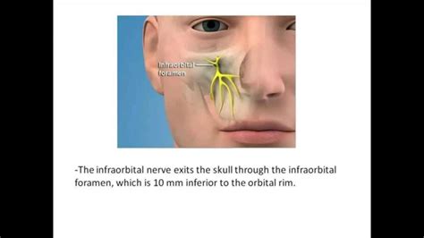 Intraoral Infraorbital Nerve Block Youtube