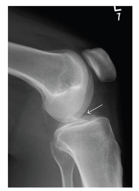 Lateral Knee Radiograph Showing A Soft Tissue Density Lesion In The