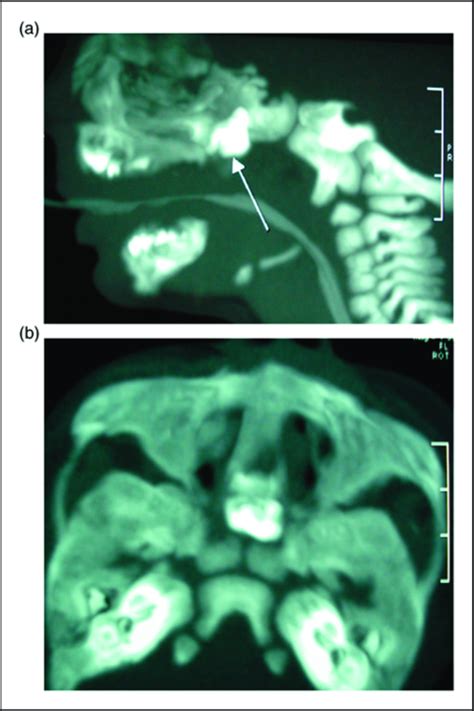 A Ct Scan Axial Section Showing Teratoma B Ct Scan Sagittal