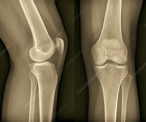 Healthy Knee X Ray Stock Image F0069125 Science Photo Library