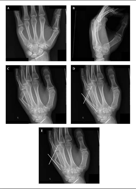 Figure 4 From Metacarpal Neck Fractures A Review Of Surgical