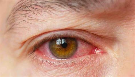 Coronavirus Eye Issues Could Be Early Covid Infection Warning Sign