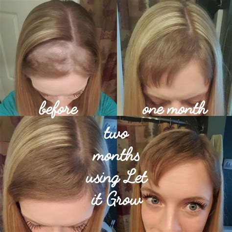 How Long For Postpartum Hair Loss To Grow Back Tips And Faqs Best