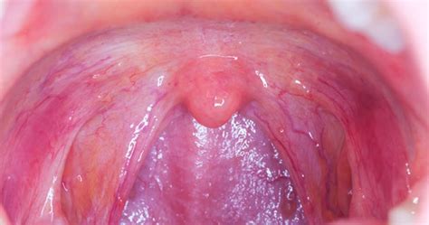 Throat Cancer Symptoms Signs Of Throat Cancer In Women One Hour Wey