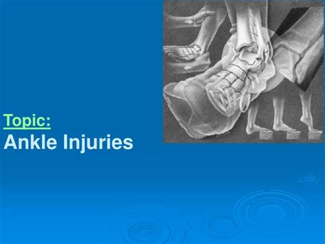 Ppt Topic Ankle Injuries Powerpoint Presentation Free Download Id