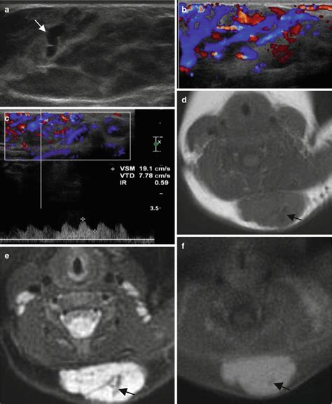 Vascular Tumors Radiology Key