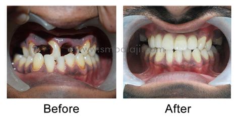 Rotten Teeth Before And After
