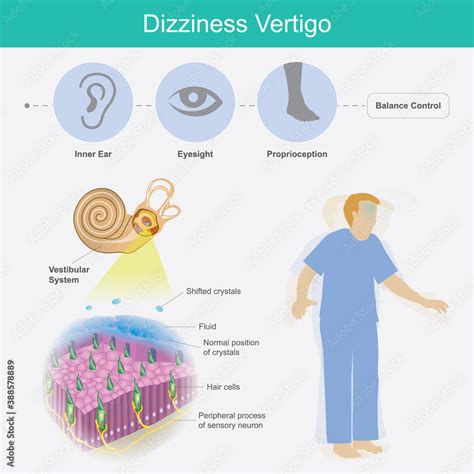 Dizziness Vertigo Illustration Explain Dizziness Vertigo By Cause Of