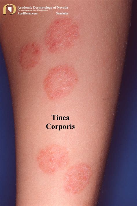 Tinea Corporis Ringworm Tinea Circinata Academic Dermatology Of Nevada