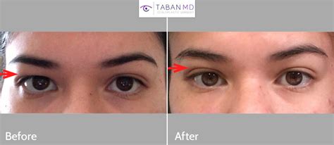 Eye Asymmetry Surgery And Treatment Fix Uneven Eyes