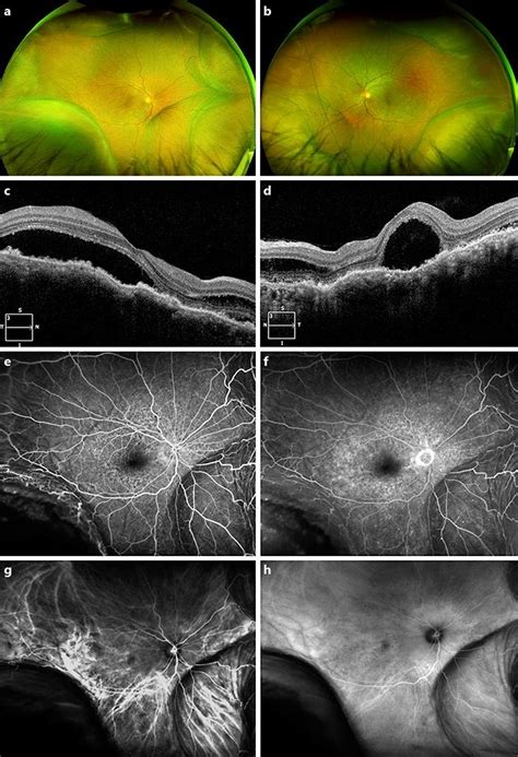 Color Fundus Photographs A B And Optical Coherence Tomography Images