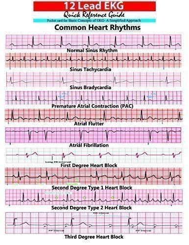 Top 10 Ekg Quick Reference Card For 2019 Infestis Reviews