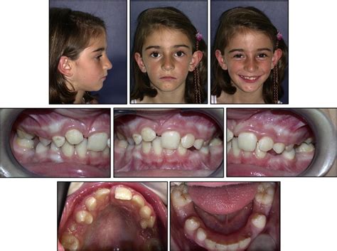 Impacted Maxillary Central Incisor Surgical Exposure And Orthodontic