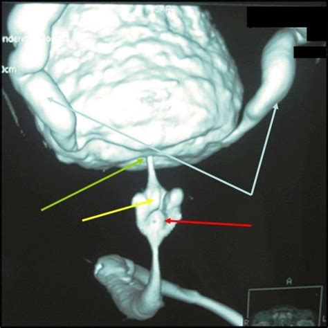 Urethroscopy A Severe Bladder Neck Contracture B Prostatic