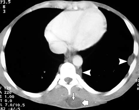 Malignant Peripheral Nerve Sheath Tumor Radiographics
