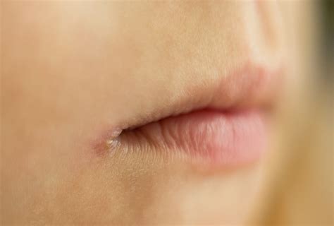 Angular Cheilitis Causes Symptoms And Treatment