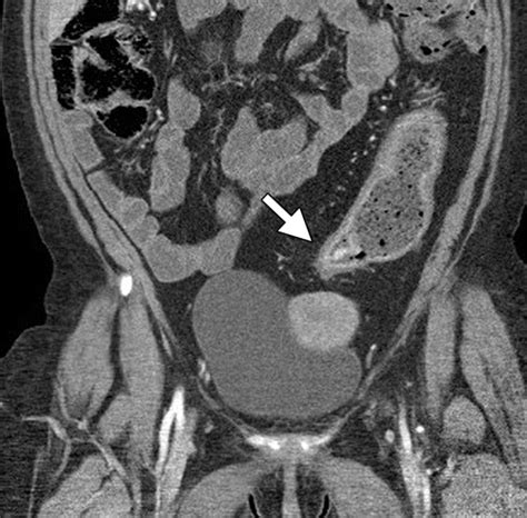 Large Bowel Obstruction In The Adult Classic Radiographic And Ct