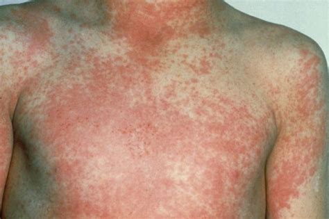 Scarlet Fever Cases Soaring To Levels Not Seen Since 1967 Heres What