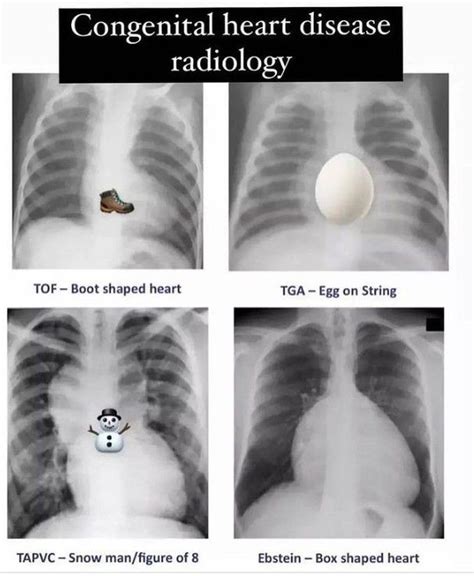 Congenital Heart Disease Radiology Medizzy