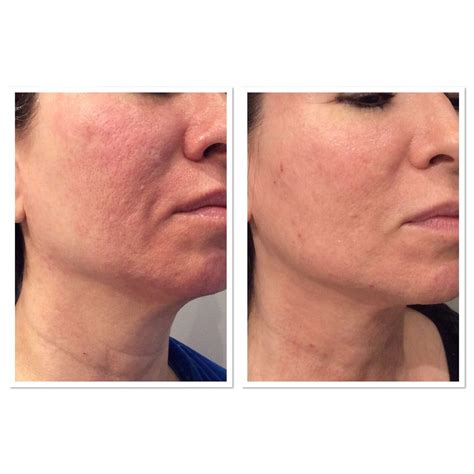 Acne Scar Before And After Treatment Parfaire Medical Aesthetics Pasadena