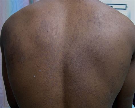 Tinea Versicolor On Back Pictures Photos