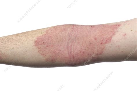 Eczema On Back Of Arms