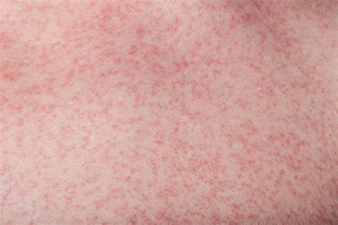 20 Different Causes Of Rashes In Babies And Their Prevention