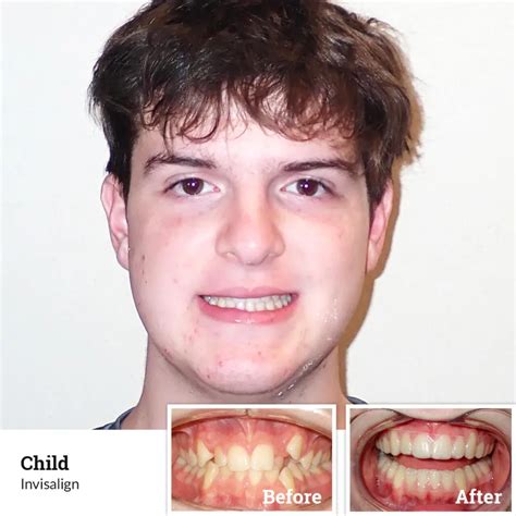 Before And After Photos Wiewiora And Dunn Orthodontics