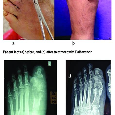Pdf Successful Treatment Of Diabetic Foot Osteomyelitis With Dalbavancin