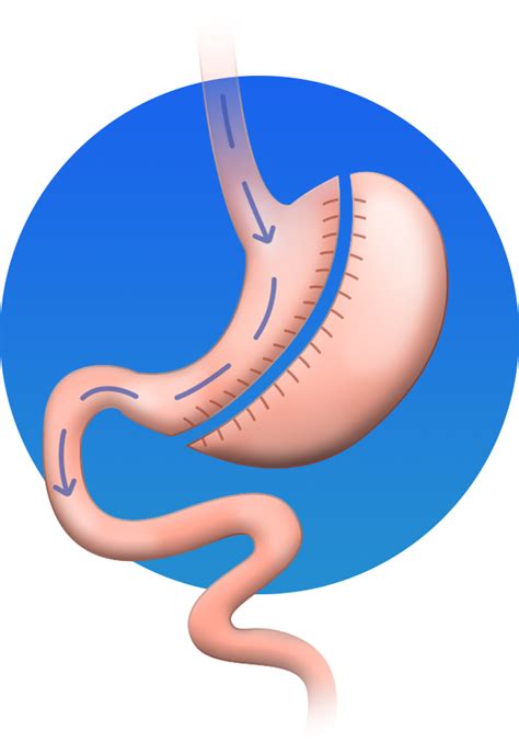 Gastric Sleeve Surgery Mexico Baristic