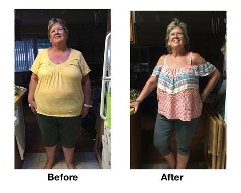 Bariatric Patient Loses Pounds Bass Bariatric Surgery Center