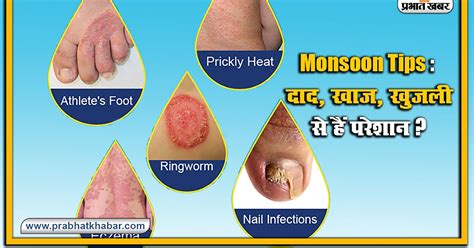 How To Remove Types Of Fungal Infections Home Remedies Itching Problem