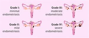 What Are The Degrees Of Endometriosis