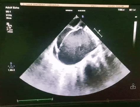 Severe Left Atrial Enlargement On Echocardiogram Grepmed