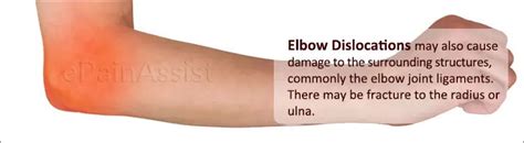 Elbow Dislocation Or Dislocated Elbowsymptomscausestreatment