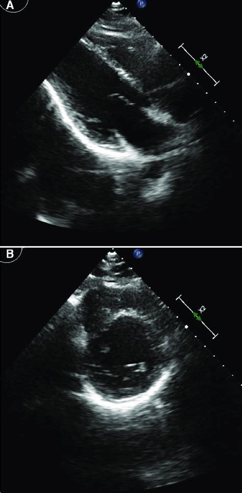A B Transthoracic Echocardiogram Showing Echo Bright Pericardium