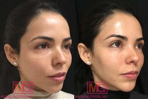 Bruising After Cheek Fillers Causes And Prevention